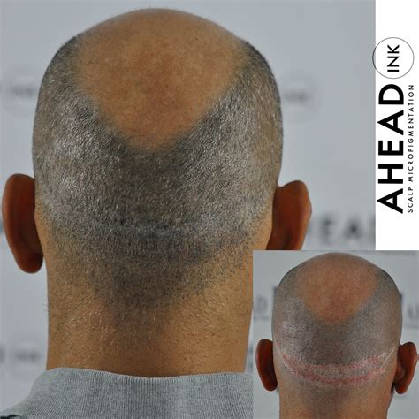 Scar Camouflage Results | Ahead Ink Scalp Micropigmentation