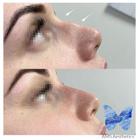 surgical rhinoplasty nose job london nose filler