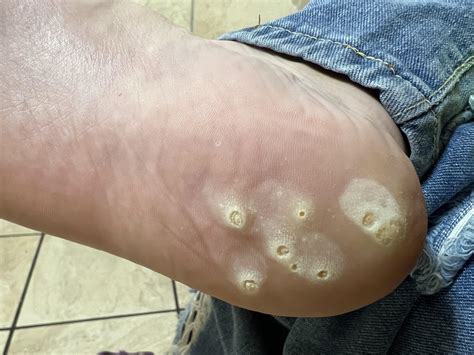 2054 best r/warts images on Pholder | Wrist wart