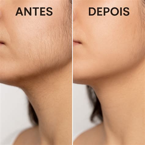 Inibidor De Pelos Labotrat Antes E Depois - Reduz Pelos e Evita Foliculite – Inibidor Facial e Corporal LABOTRAT ...