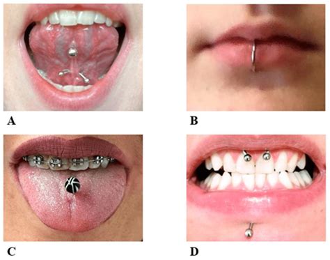 Oral Complications Associated with the Piercing of Oral and Perioral