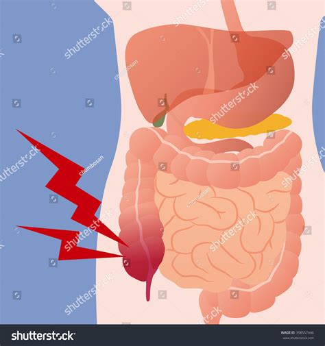 699 Appendectomy Images, Stock Photos & Vectors | Shutterstock