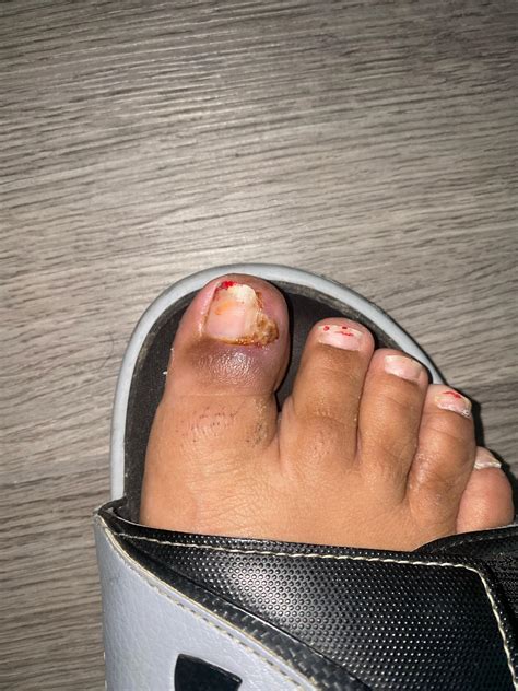 Table Salt Ingrown Toenail at Cynthia Hewlett blog