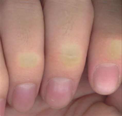 nails  cuticle picking skinpickcom