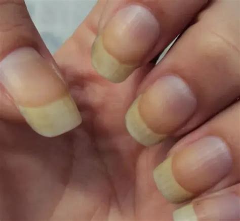 Unha Amarelada Por Esmalte - Unhas Amareladas por Esmalte? Descubra o Tratamento Rápido!