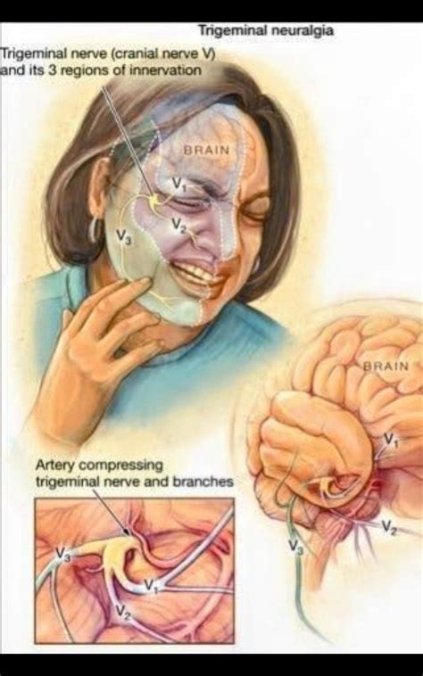 Migraine Headaches And Trigeminal Neuralgia Are Examples Of 5
