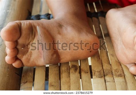 Blisters On Soles Childs Feet Blister Stock Photo 2378615279 | Shutterstock