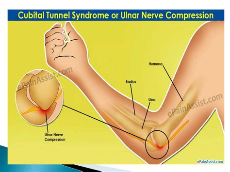 Cubital Tunnel Syndrome | PPTX