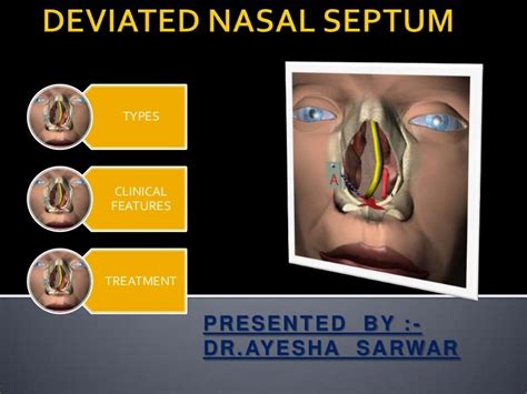 Deviated nasal septum