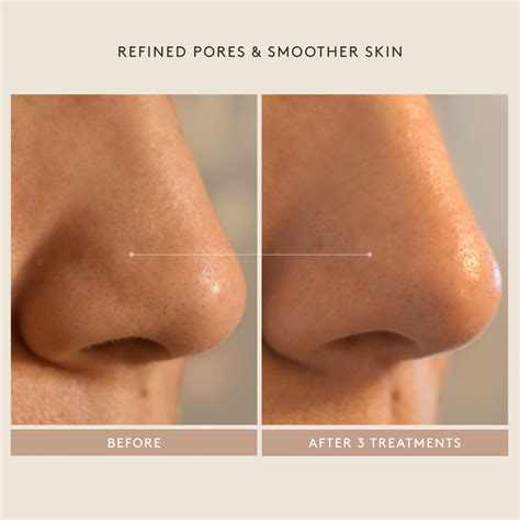 Triple Acid Signature Peel | Shani Darden Skin Care