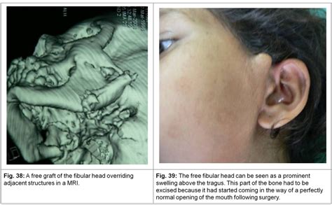 ankylosis   temporo mandibular jointjoints tmj short