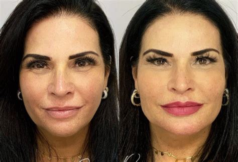 Lisa Gomes Antes E Depois Cirurgia - Foto: Solange Gomes antes e depois da harmonização facial - Purepeople
