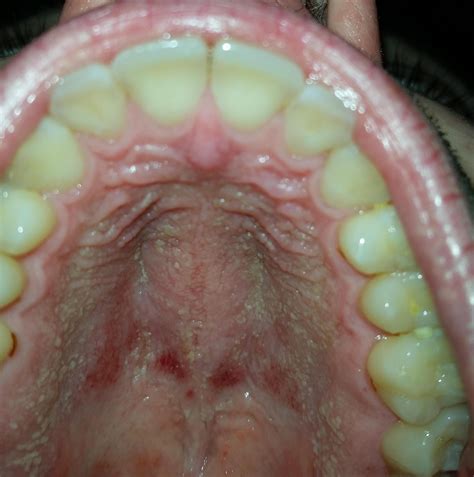 bruised roof   mouth bruised roof   mouth  symptoms
