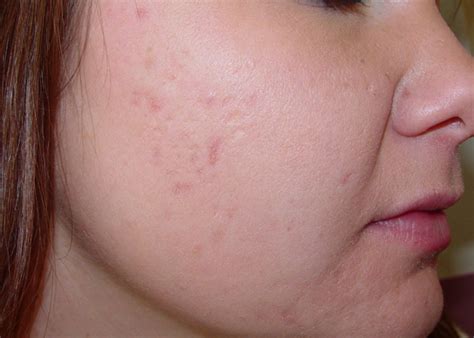 Neonatal Acne (Acne - neonatal and infantile) - Dermatology Advisor