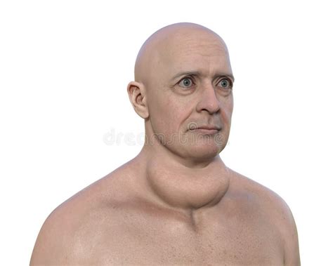A Man with Enlarged Thyroid Gland, 3D Illustration Stock Illustration ...