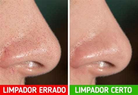 O Que São Poros Dilatados - 10 Dicas de dermatologistas que podem ajudar a diminuir os poros dilatados
