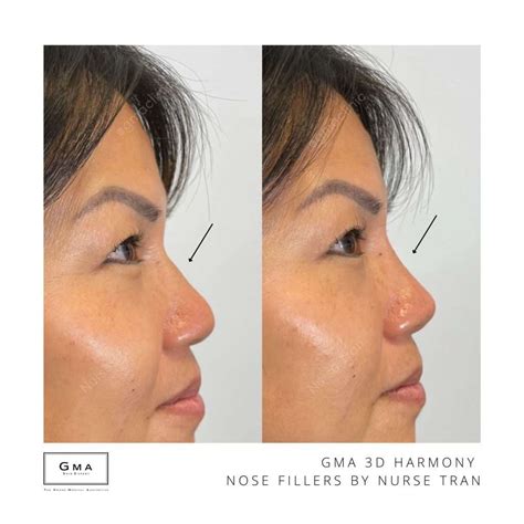 dermal fillers  grand medical aesthetic clinic