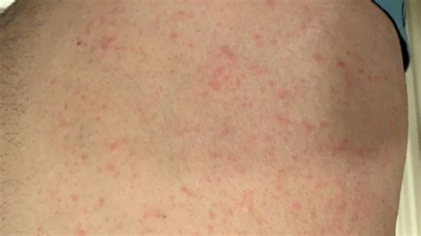 Skin Rashes Dermatitis Eczema | Images and Photos finder