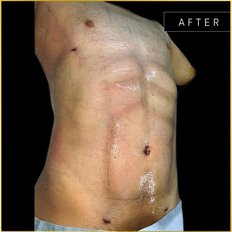 Before & After – Liposser