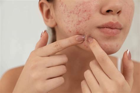 Dermatological Treatments for Acne Scars vs Home Treatments - Stratum