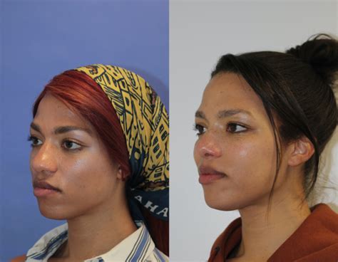 Rhinoplasty Before And After Bulbous Tip