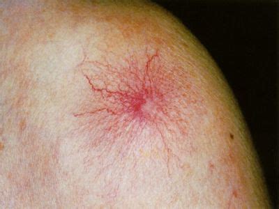肝硬変でクモ状血管腫ができる理由 - どすこい研修医