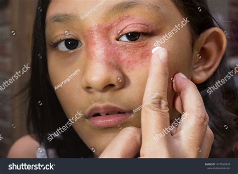 circular rash images stock  vectors shutterstock