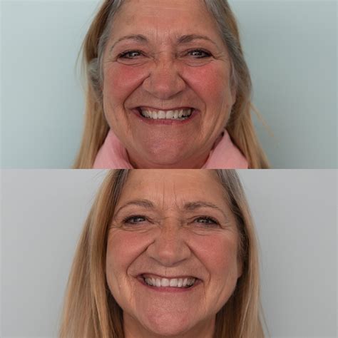 Teeth Whitening | Clarence Street Dental