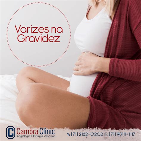 Como Ficam As Veias No Inicio Da Gravidez - Causas das varizes na gravidez - Cambra Clinic