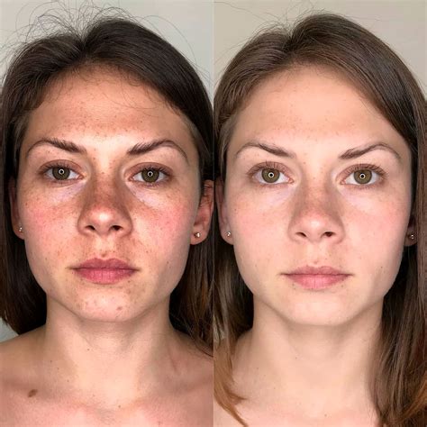 Карбоновый пилинг в Алматы, активное очищение и лифтинг!
