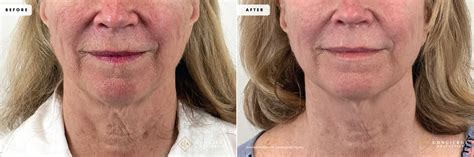 Before and After Photo: CoolPeel and Deka CO2 Laser Skin Transformation