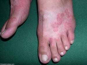 FUNGAL INFECTIONS OF THE SKIN - Podiatry HQ