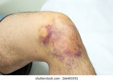 huge upper  abscess require drainage stock photo edit