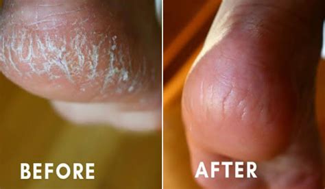 Easy Tip To Heal Cracked Feet - Oman Jobvacancy