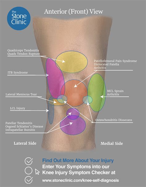 Knee Pain Location Chart Knee Pain Location Chart Sport Doctor
