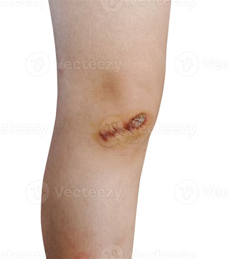 knee cut era 12