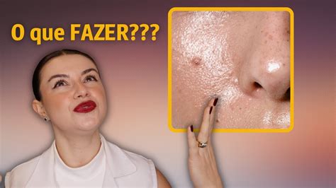 Pele Muito Oleosa De Repente - 3 dicas de como cuidar de uma pele MUITO oleosa | Dica de Esteticista e ...