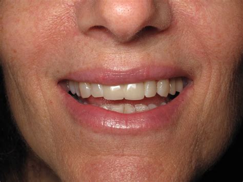 Front Tooth Bone Loss and Dental Implant Replacement