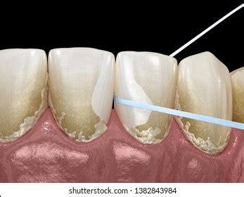 Oral Hygiene Using Dental Floss Plaque Stock Illustration 1797489913 ...