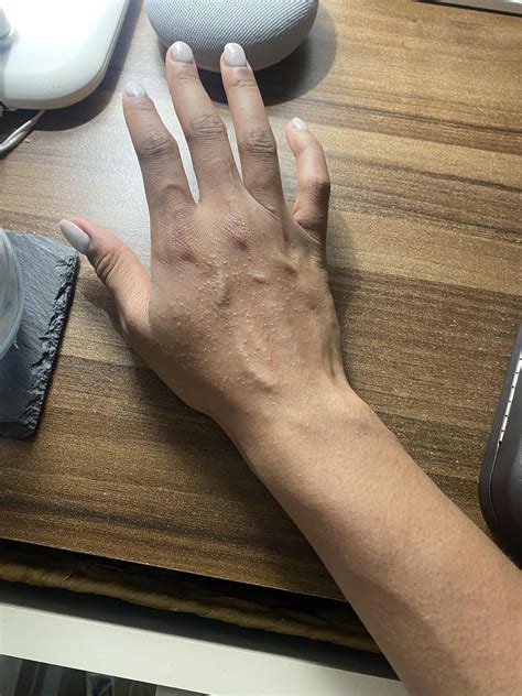 Solar Urticaria, Polymorphic light eruption, or just plain old Chronic
