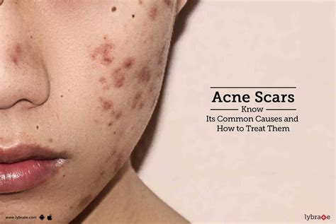 Acne Scars - Know Its Common Causes and How to Treat Them - By Dr ...