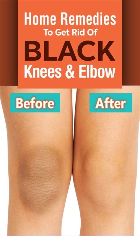how to get rid of black knees