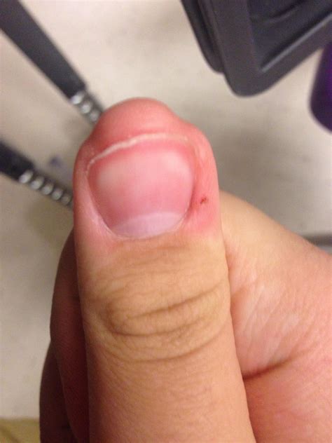 Why Does My Thumb Look like Tyler's Head Meat ? : r/loltyler1