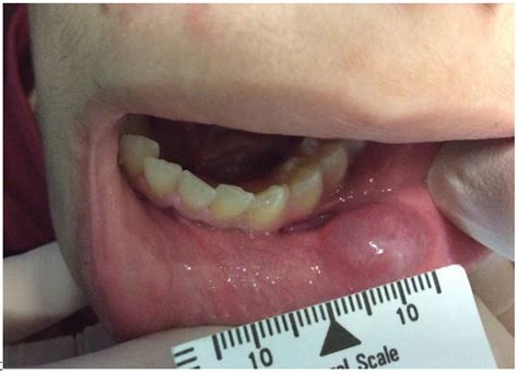 Mucocele Floor Of Mouth