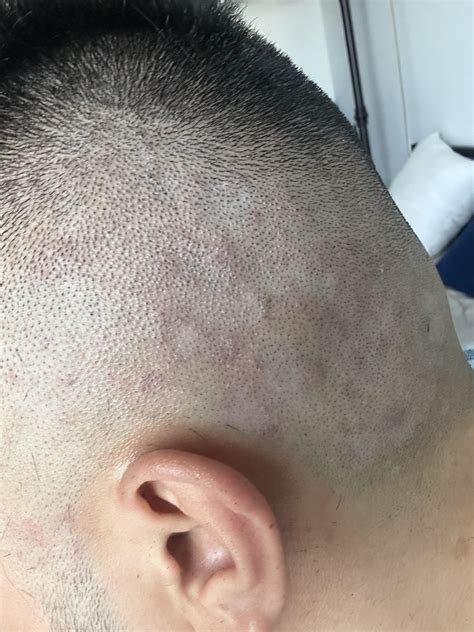 What are these red blotches on my scalp? How do I get rid of them? : r