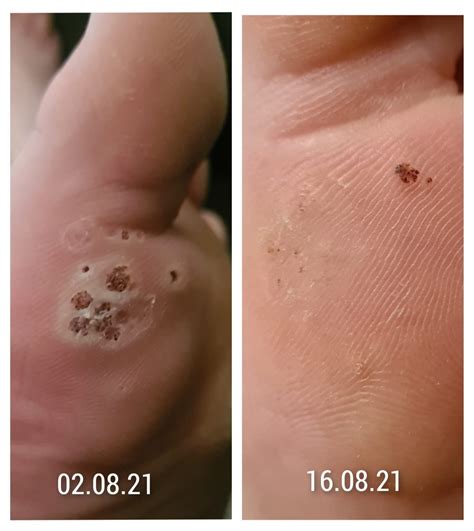 Case Study: Successfully Treating A Foot Covered In Plantar Warts