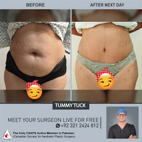 Tummy Tuck Before & After Results - Cosmetic Surgeon