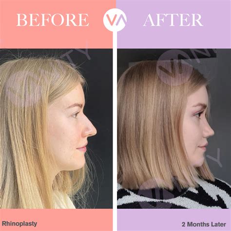 Upturned Nose Attractive Choosing The Right Nose Shape And Size For