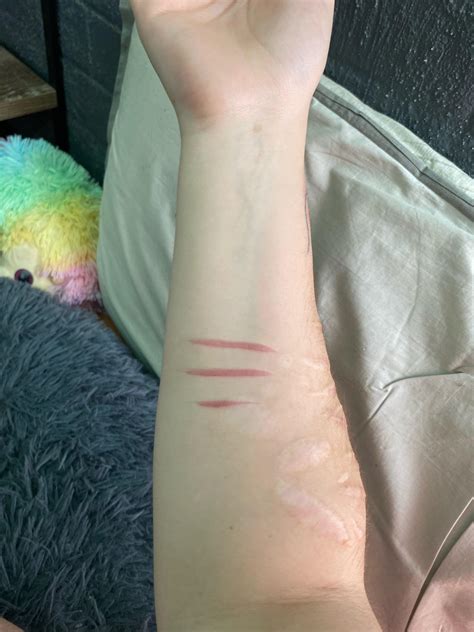 These hurt so much!!! Pls help : r/SelfHarmScars