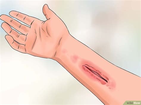 Corte Profundo Que Não Sangra - 4 Formas de Tratar Cortes Profundos - wikiHow